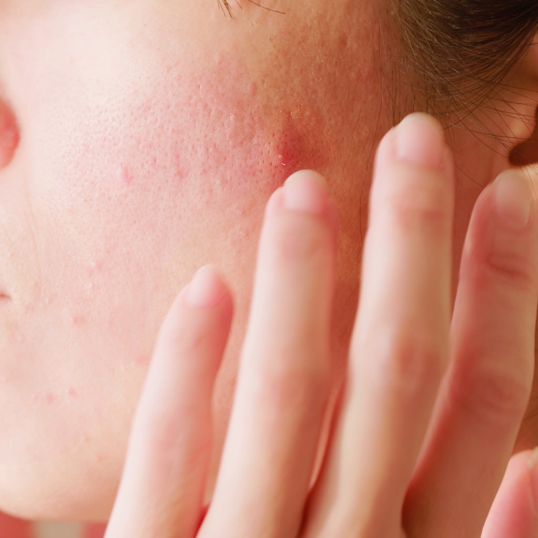Fall Skin Problem Fall In Love with Your Autumnal Skin: Essential Tips for a Radiant Com ...